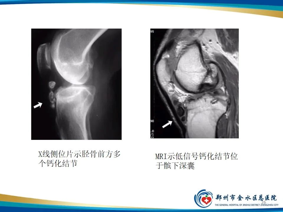 影像PPT - 【PPT】色素沉着绒毛结节性滑膜炎-26