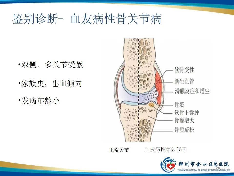 影像PPT - 【PPT】色素沉着绒毛结节性滑膜炎-28