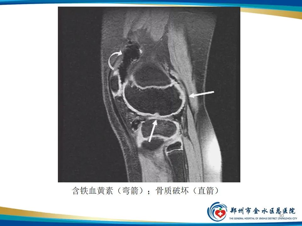 影像PPT - 【PPT】色素沉着绒毛结节性滑膜炎-30