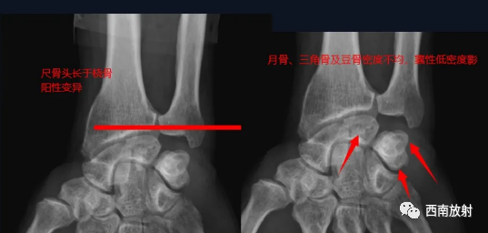 影像PPT - TFCC损伤-8