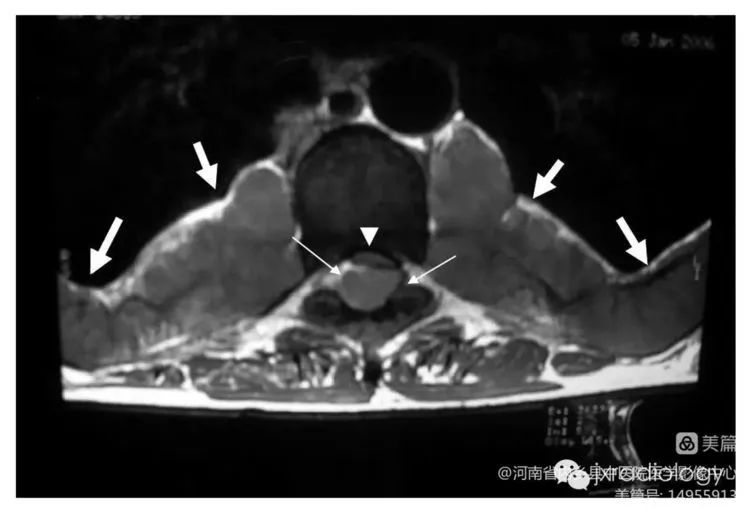 影像PPT - 您知道什么是“葫芦征”吗-2 影像PPT - 您知道什么是“葫芦征”吗-2