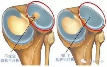 影像PPT - 盘状半月板的影像学征象-1 影像PPT - 盘状半月板的影像学征象-1