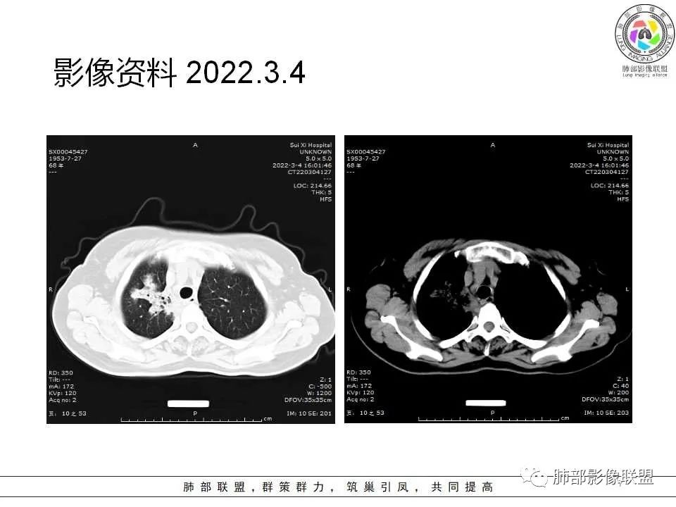影像PPT - 【病例】慢性嗜酸性粒细胞肺炎影像分析-7 影像PPT - 【病例】慢性嗜酸性粒细胞肺炎影像分析-7
