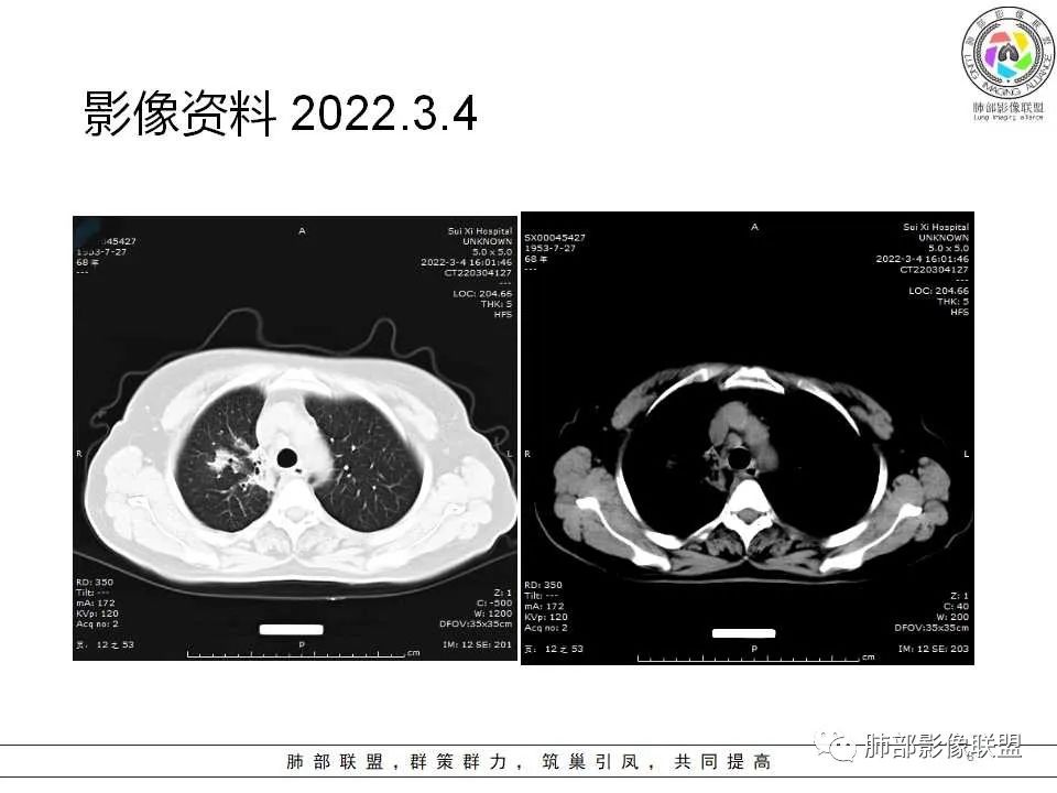 影像PPT - 【病例】慢性嗜酸性粒细胞肺炎影像分析-8 影像PPT - 【病例】慢性嗜酸性粒细胞肺炎影像分析-8