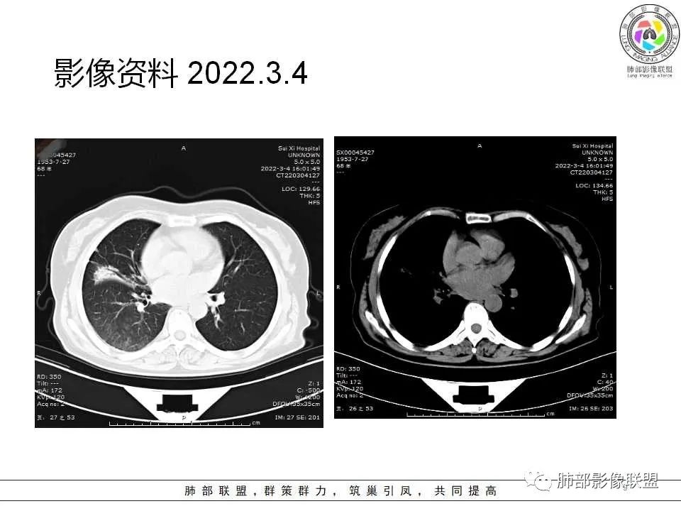 影像PPT - 【病例】慢性嗜酸性粒细胞肺炎影像分析-9 影像PPT - 【病例】慢性嗜酸性粒细胞肺炎影像分析-9