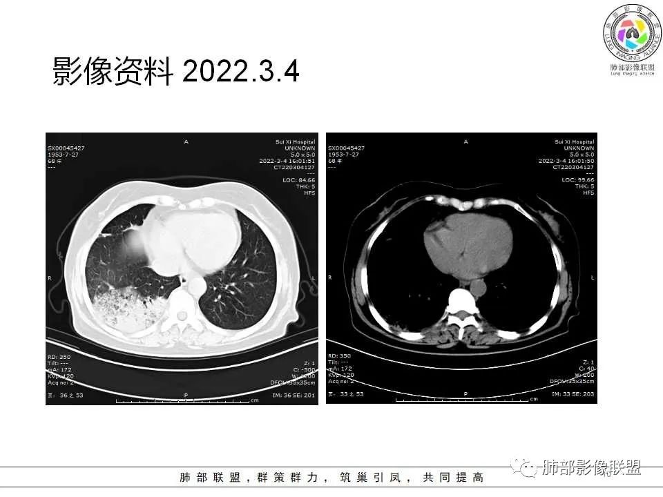 影像PPT - 【病例】慢性嗜酸性粒细胞肺炎影像分析-10 影像PPT - 【病例】慢性嗜酸性粒细胞肺炎影像分析-10