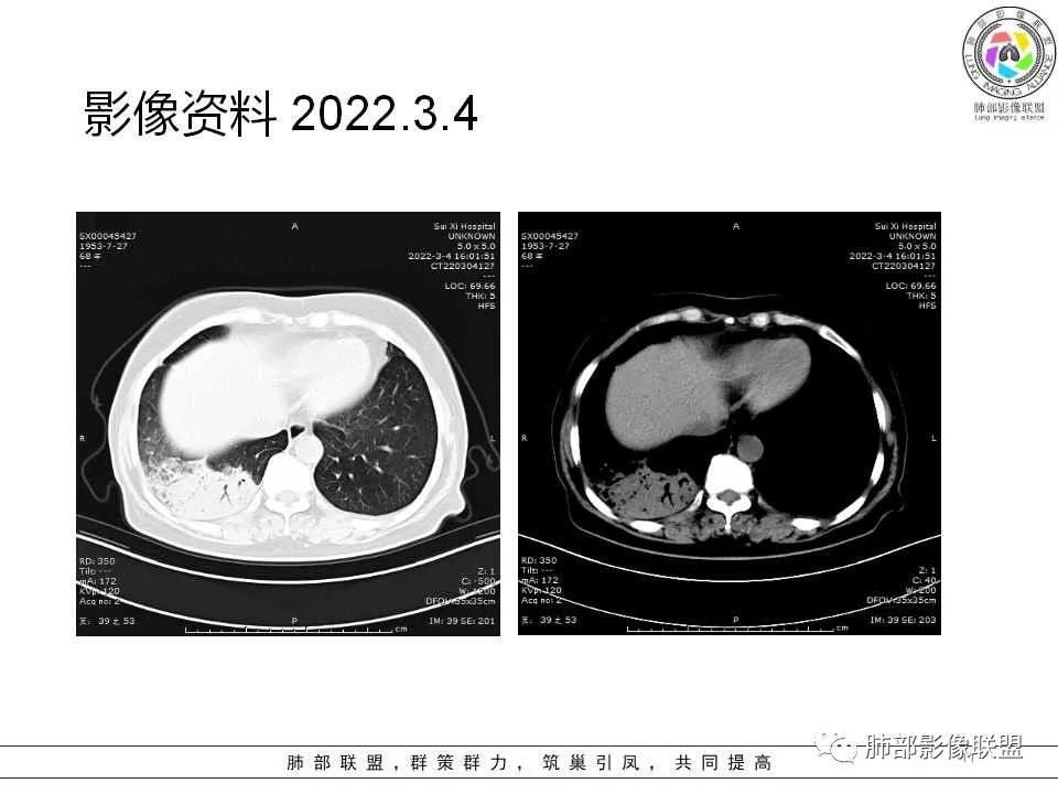 影像PPT - 【病例】慢性嗜酸性粒细胞肺炎影像分析-11 影像PPT - 【病例】慢性嗜酸性粒细胞肺炎影像分析-11