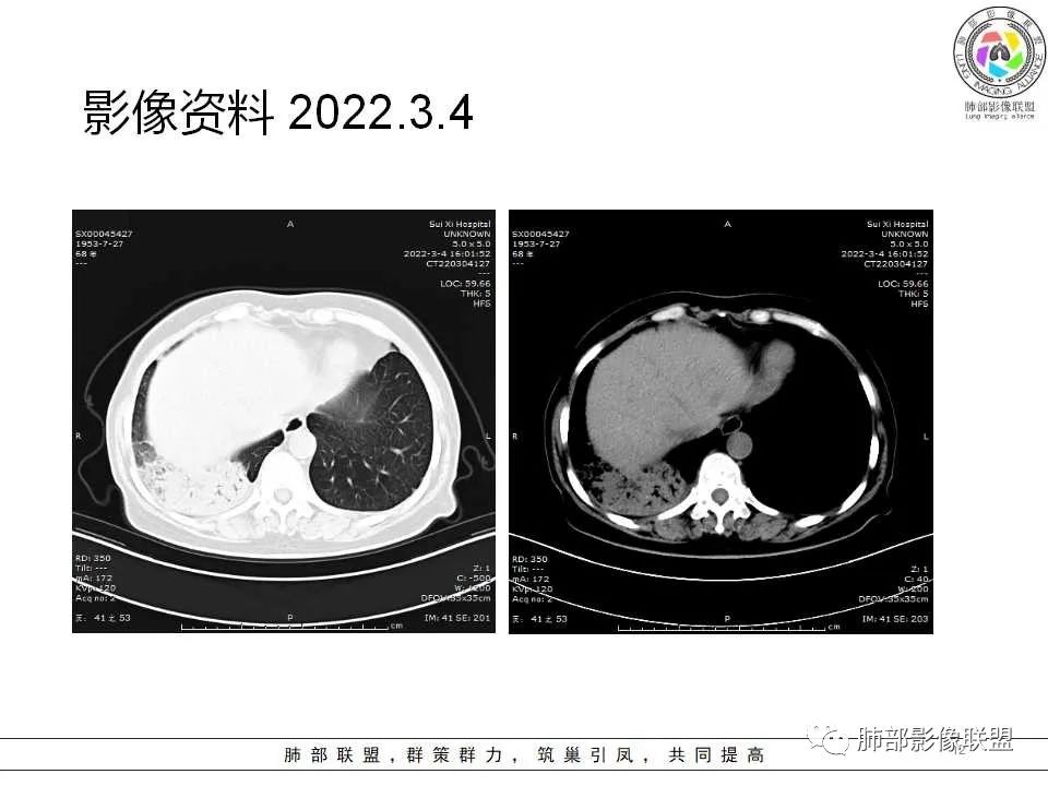 影像PPT - 【病例】慢性嗜酸性粒细胞肺炎影像分析-12 影像PPT - 【病例】慢性嗜酸性粒细胞肺炎影像分析-12