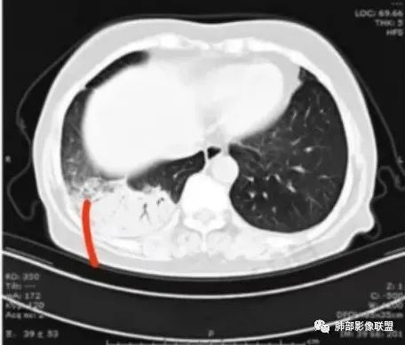 影像PPT - 【病例】慢性嗜酸性粒细胞肺炎影像分析-17 影像PPT - 【病例】慢性嗜酸性粒细胞肺炎影像分析-17