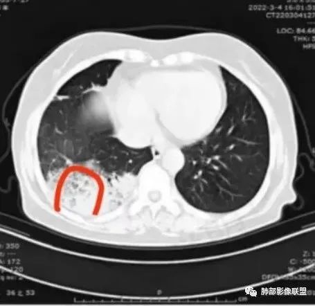 影像PPT - 【病例】慢性嗜酸性粒细胞肺炎影像分析-18 影像PPT - 【病例】慢性嗜酸性粒细胞肺炎影像分析-18