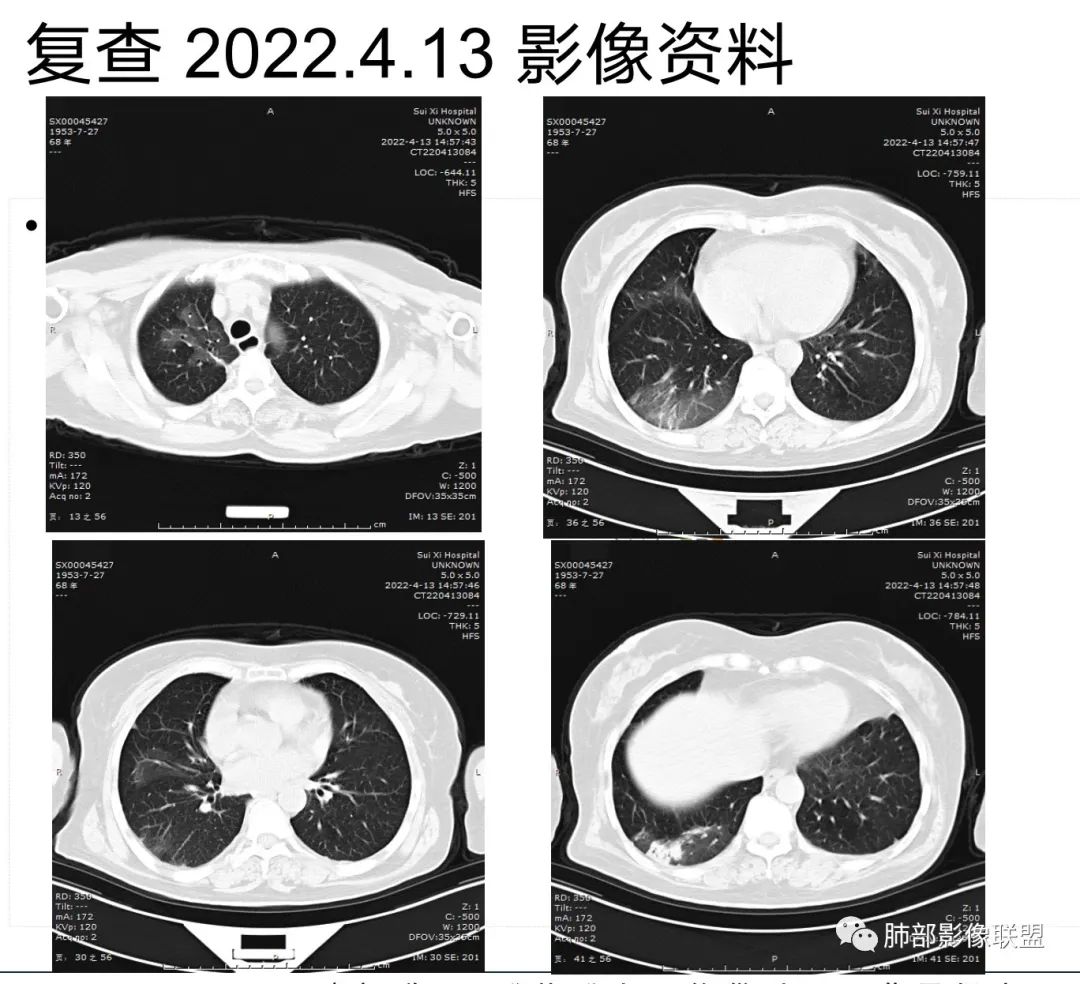 影像PPT - 【病例】慢性嗜酸性粒细胞肺炎影像分析-31 影像PPT - 【病例】慢性嗜酸性粒细胞肺炎影像分析-31