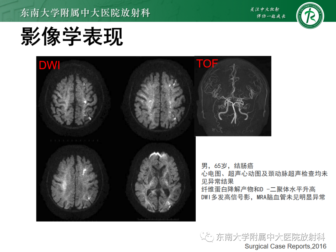 影像PPT - 【PPT】特鲁索综合征-10 影像PPT - 【PPT】特鲁索综合征-10