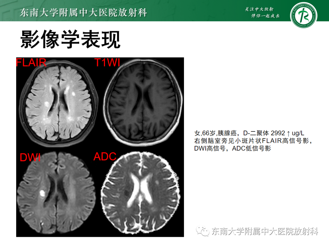 影像PPT - 【PPT】特鲁索综合征-9 影像PPT - 【PPT】特鲁索综合征-9