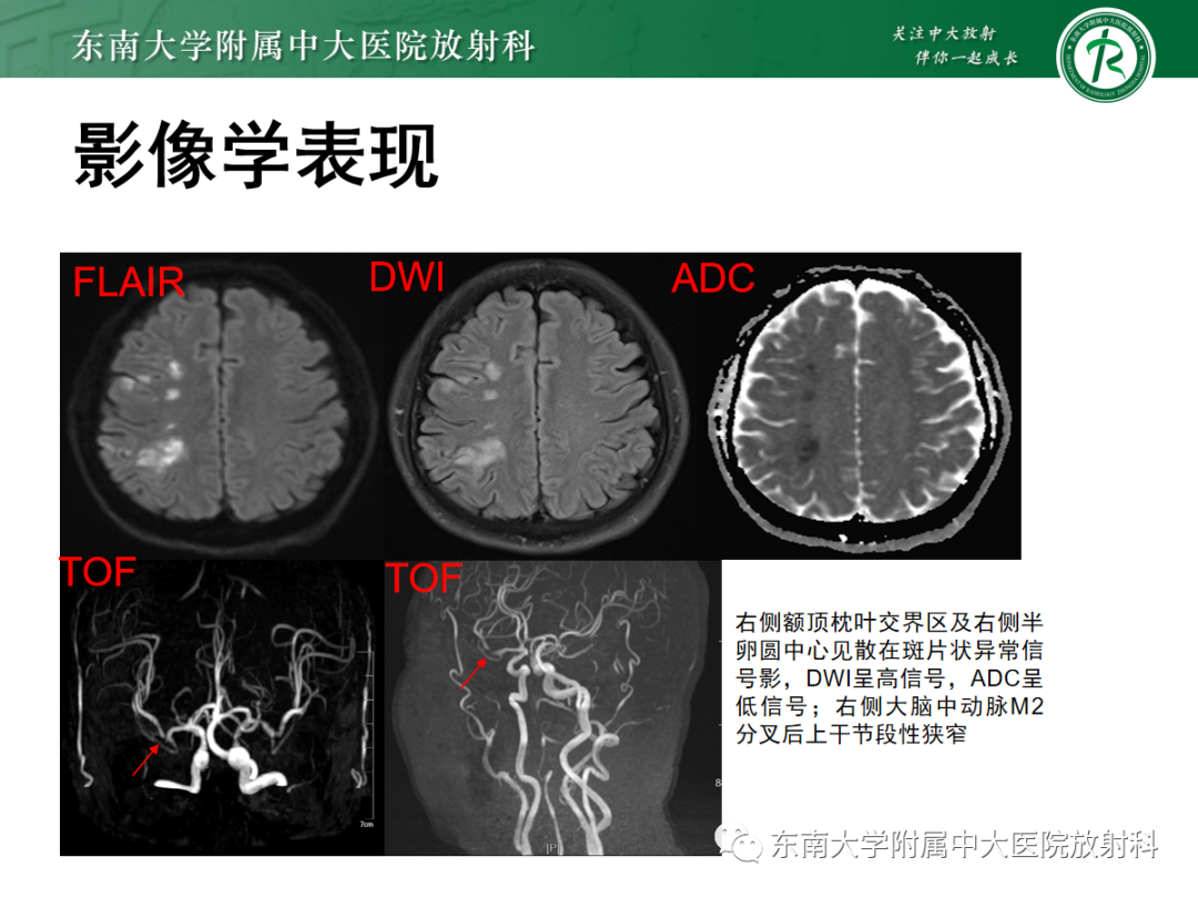 影像PPT - 【PPT】特鲁索综合征-15 影像PPT - 【PPT】特鲁索综合征-15