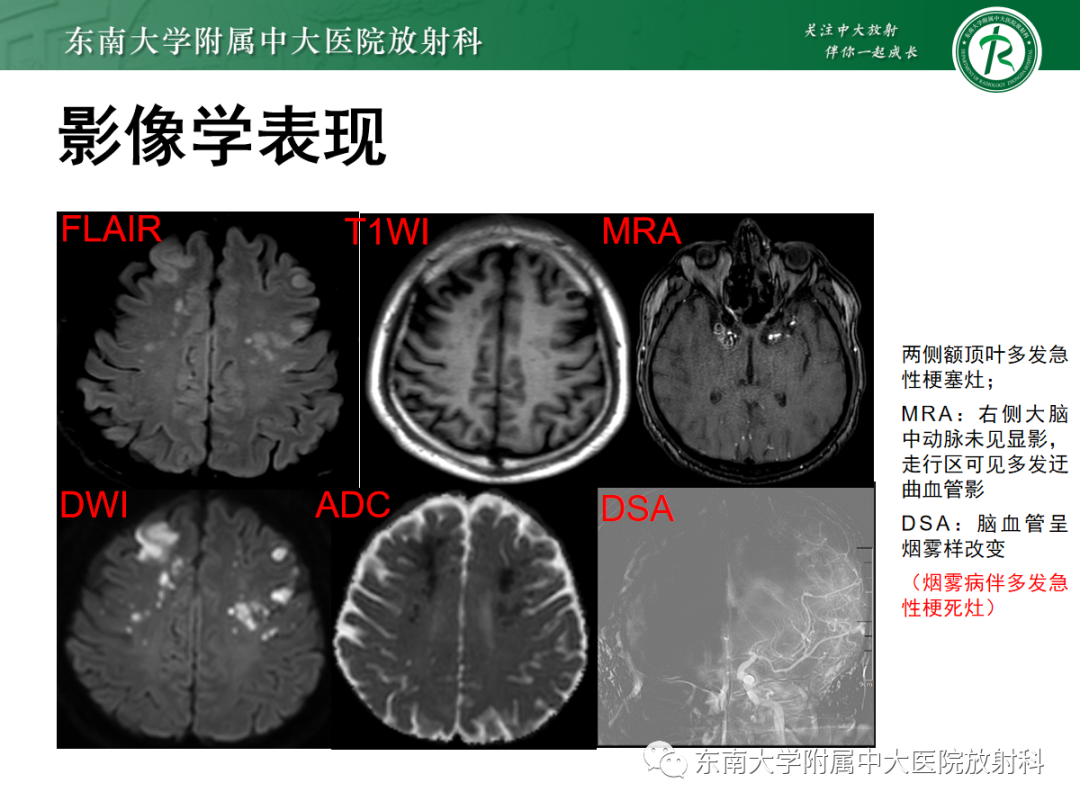 影像PPT - 【PPT】特鲁索综合征-16 影像PPT - 【PPT】特鲁索综合征-16