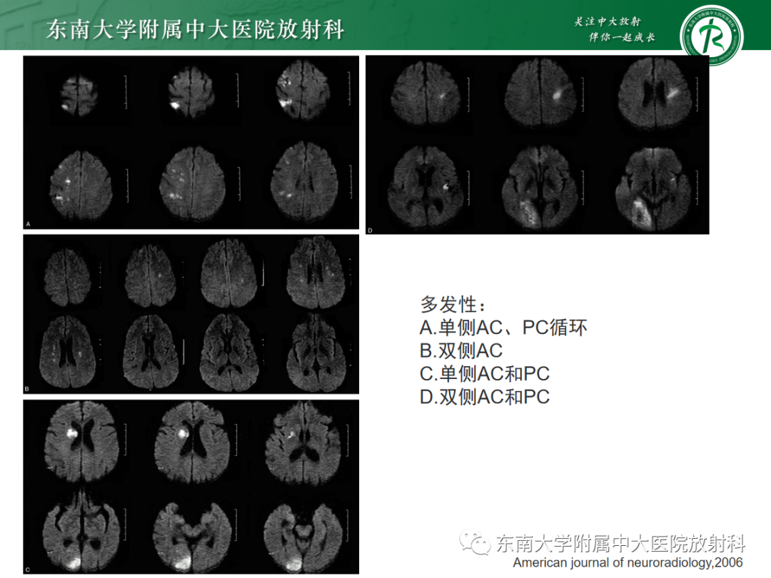 影像PPT - 【PPT】特鲁索综合征-19 影像PPT - 【PPT】特鲁索综合征-19