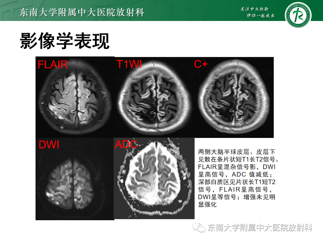 影像PPT - 【PPT】特鲁索综合征-21 影像PPT - 【PPT】特鲁索综合征-21