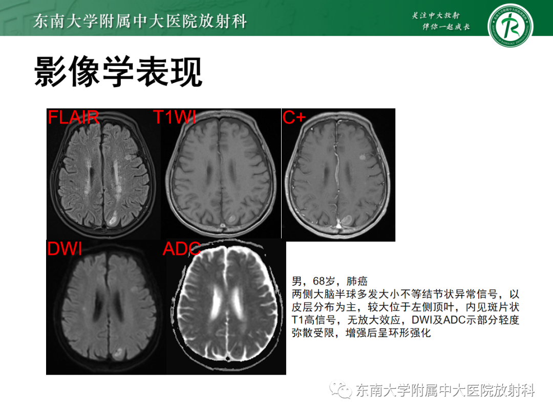 影像PPT - 【PPT】特鲁索综合征-23 影像PPT - 【PPT】特鲁索综合征-23