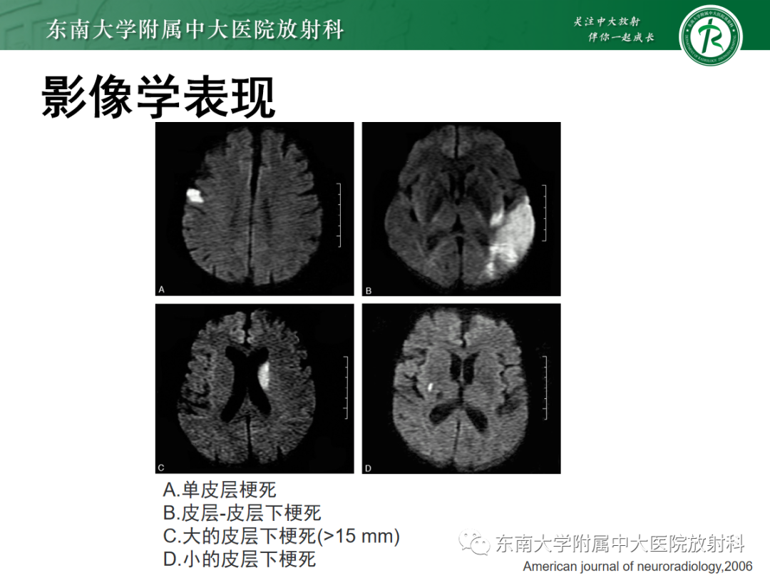 影像PPT - 【PPT】特鲁索综合征-18 影像PPT - 【PPT】特鲁索综合征-18