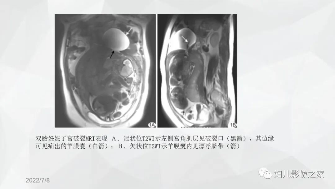 影像PPT - 【PPT】子宫破裂的影像诊断-10