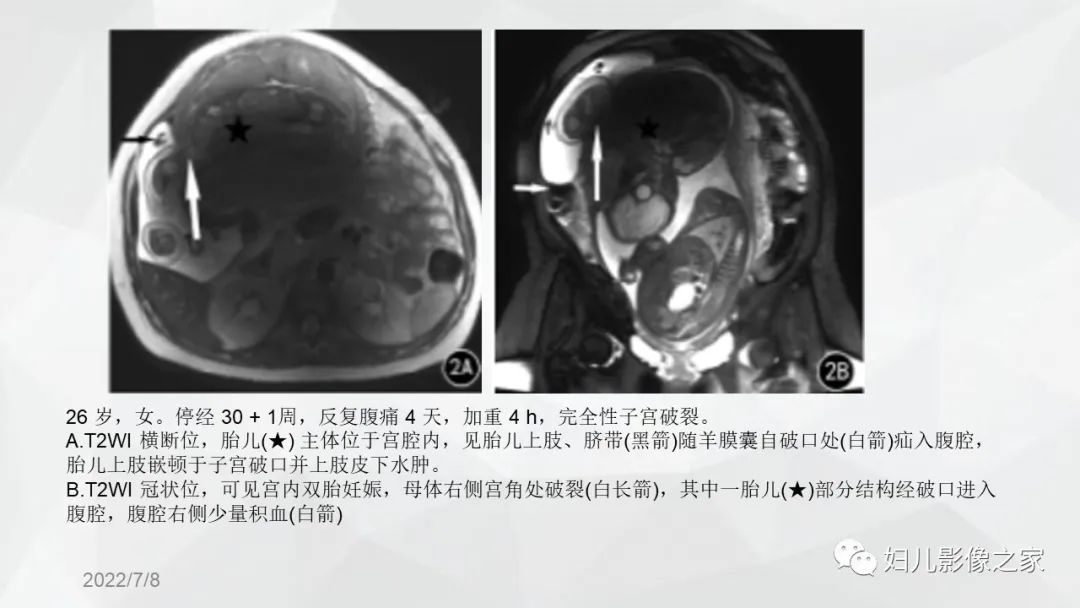 影像PPT - 【PPT】子宫破裂的影像诊断-11