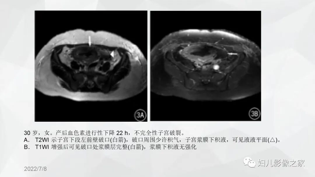 影像PPT - 【PPT】子宫破裂的影像诊断-12