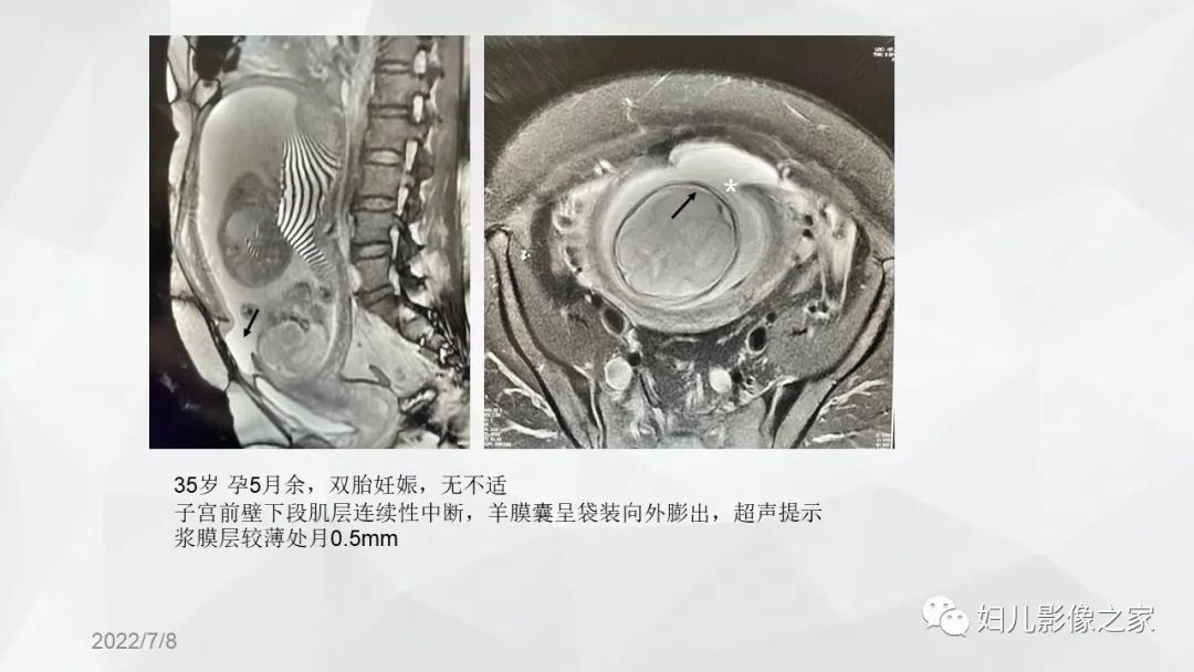 影像PPT - 【PPT】子宫破裂的影像诊断-13