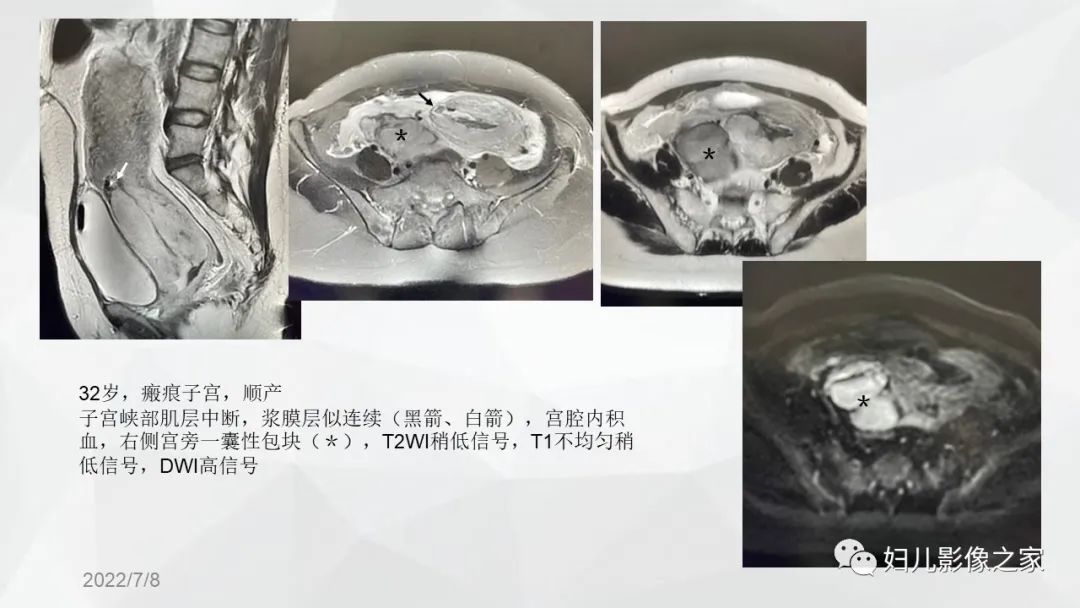 影像PPT - 【PPT】子宫破裂的影像诊断-14