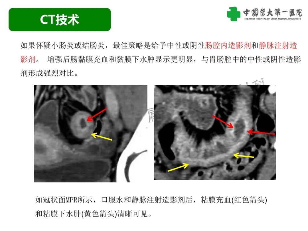 影像PPT - 【PPT】急性感染性 炎症性及缺血性肠炎的鉴别-5