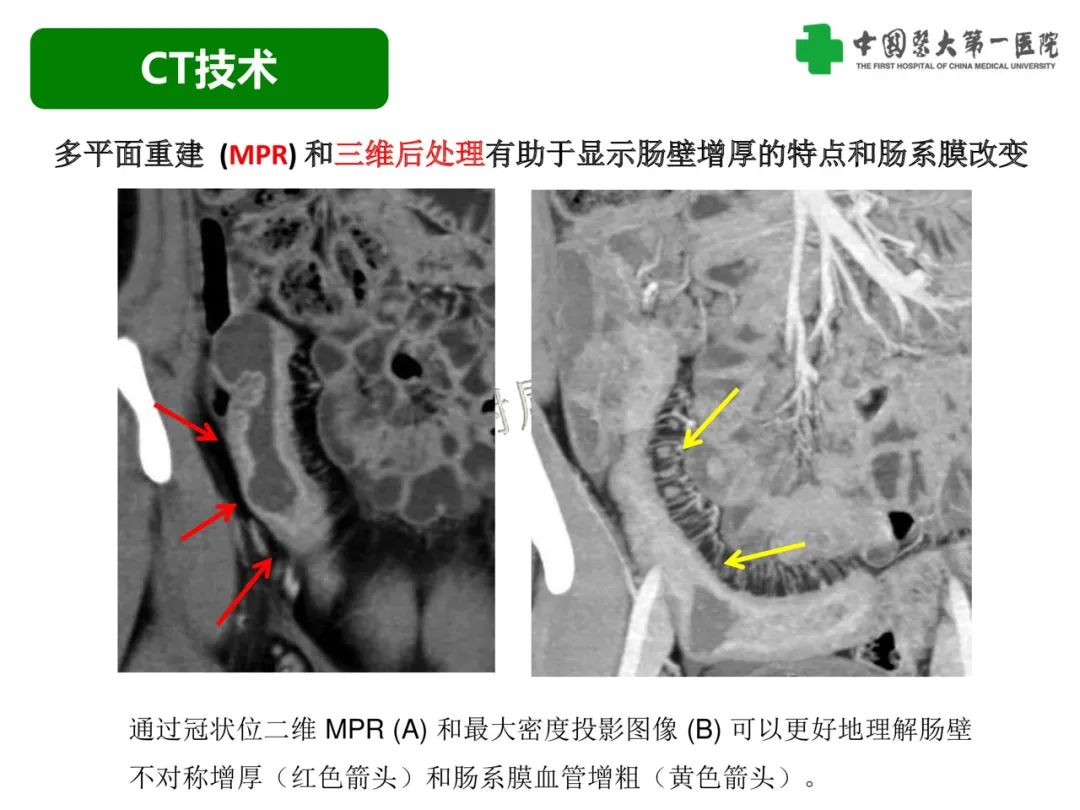 影像PPT - 【PPT】急性感染性 炎症性及缺血性肠炎的鉴别-6
