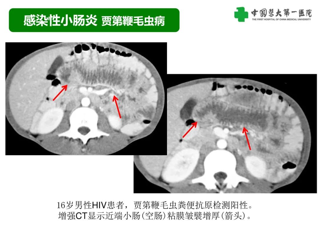 影像PPT - 【PPT】急性感染性 炎症性及缺血性肠炎的鉴别-10