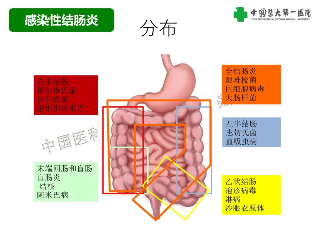 影像PPT - 【PPT】急性感染性 炎症性及缺血性肠炎的鉴别-12