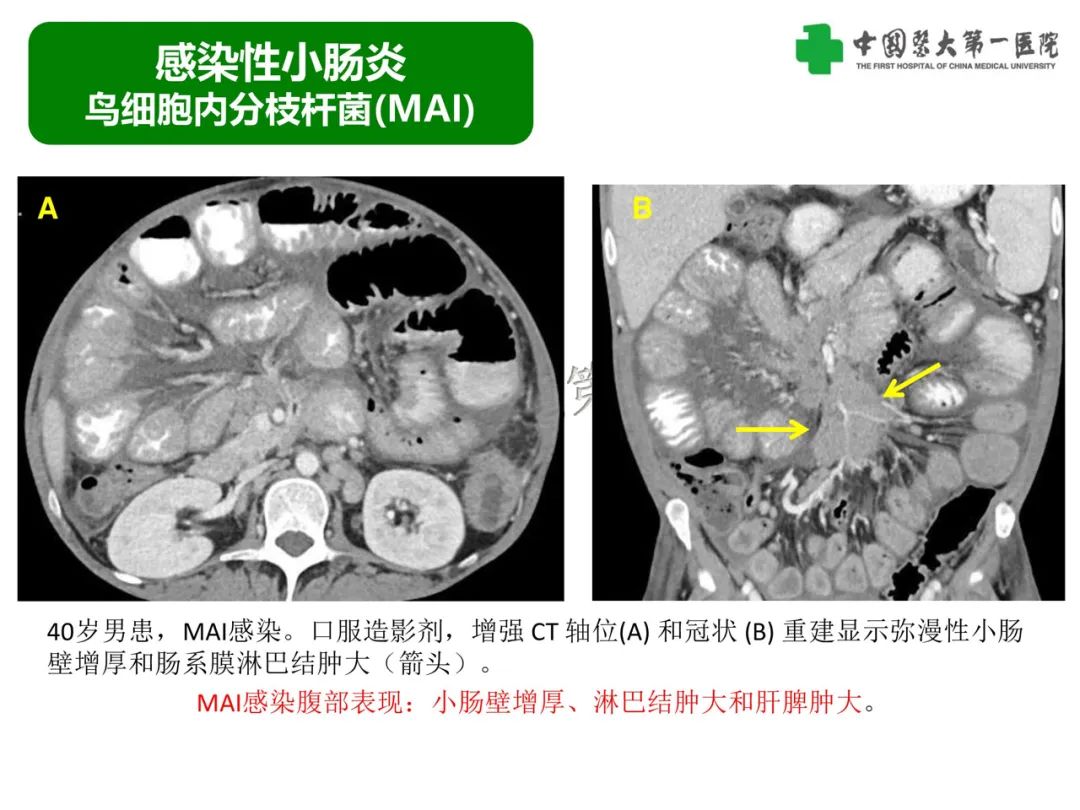 影像PPT - 【PPT】急性感染性 炎症性及缺血性肠炎的鉴别-11