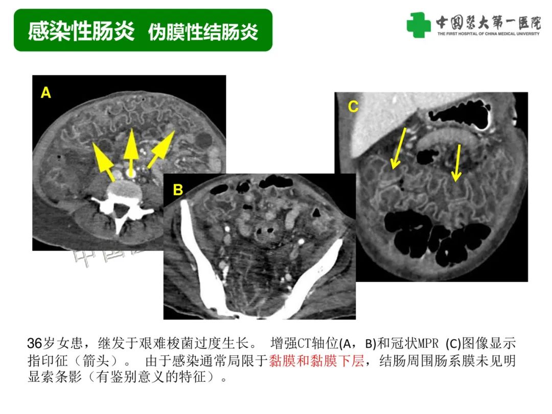 影像PPT - 【PPT】急性感染性 炎症性及缺血性肠炎的鉴别-14