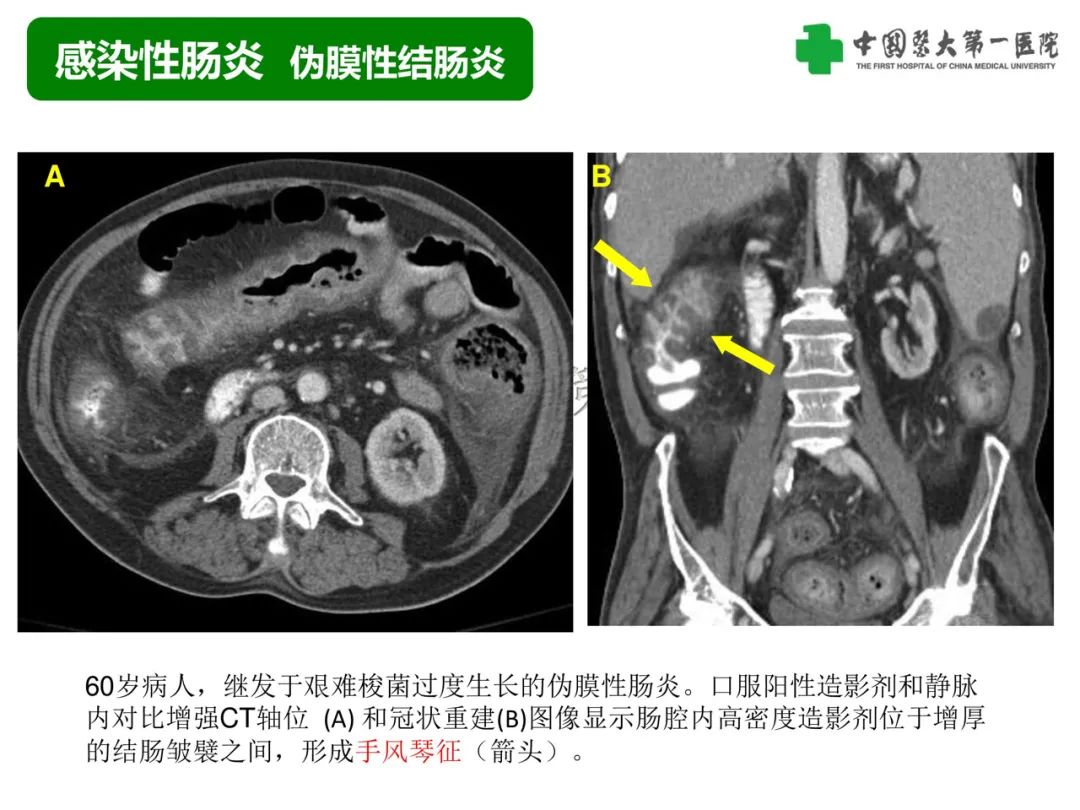 影像PPT - 【PPT】急性感染性 炎症性及缺血性肠炎的鉴别-15