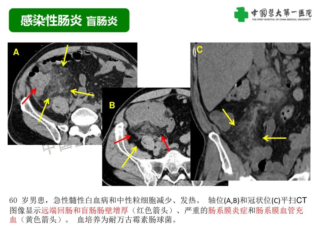 影像PPT - 【PPT】急性感染性 炎症性及缺血性肠炎的鉴别-17