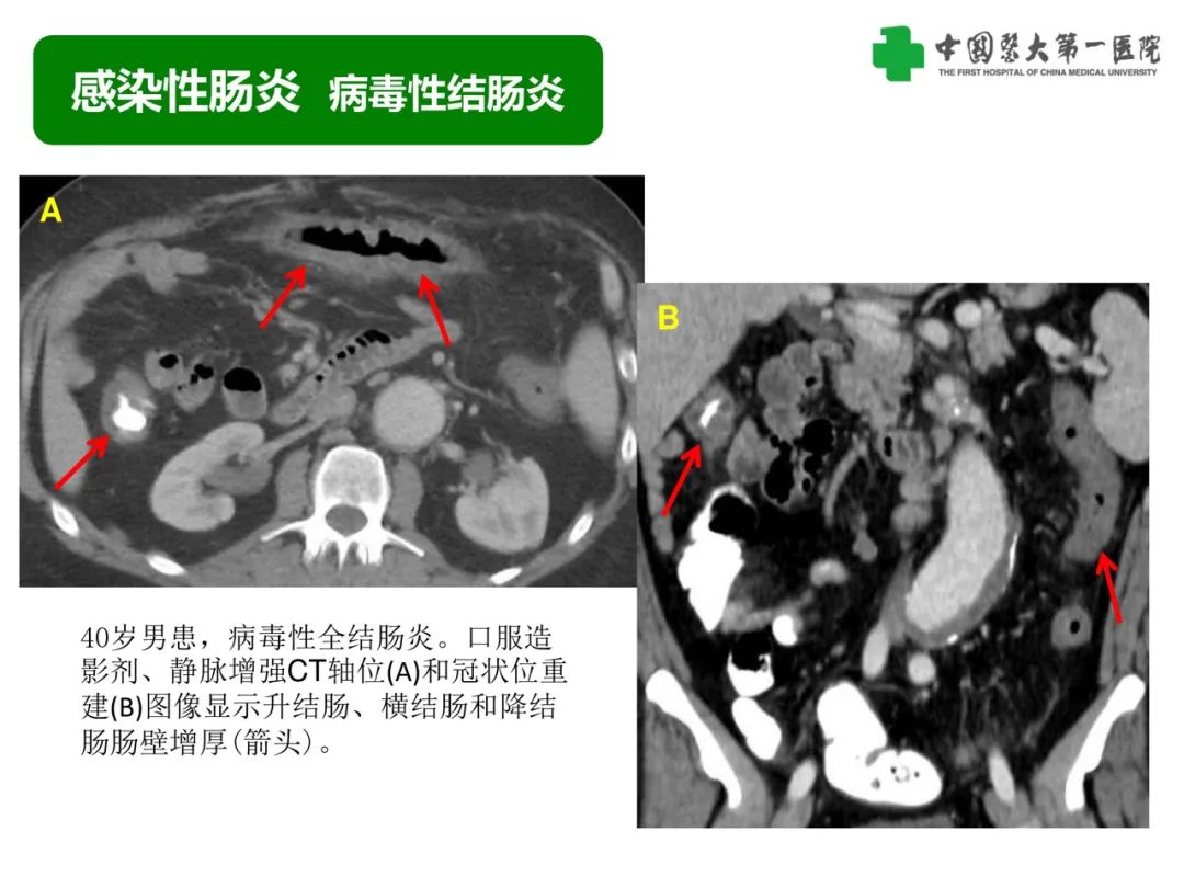 影像PPT - 【PPT】急性感染性 炎症性及缺血性肠炎的鉴别-18
