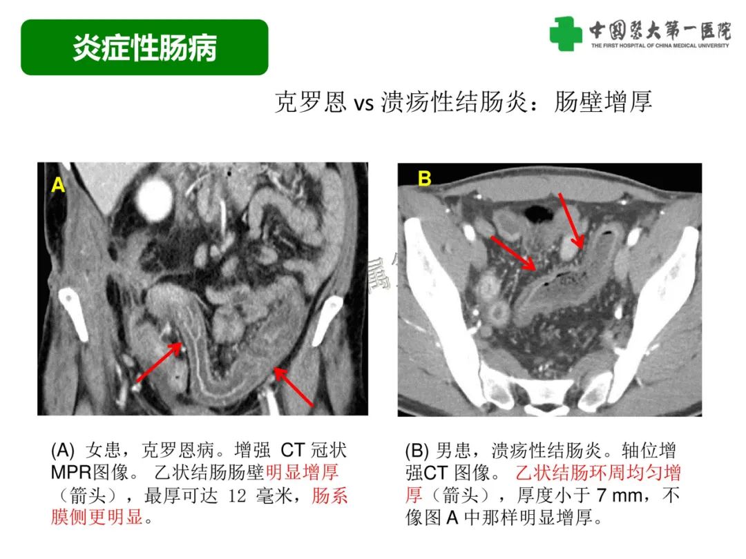 影像PPT - 【PPT】急性感染性 炎症性及缺血性肠炎的鉴别-21