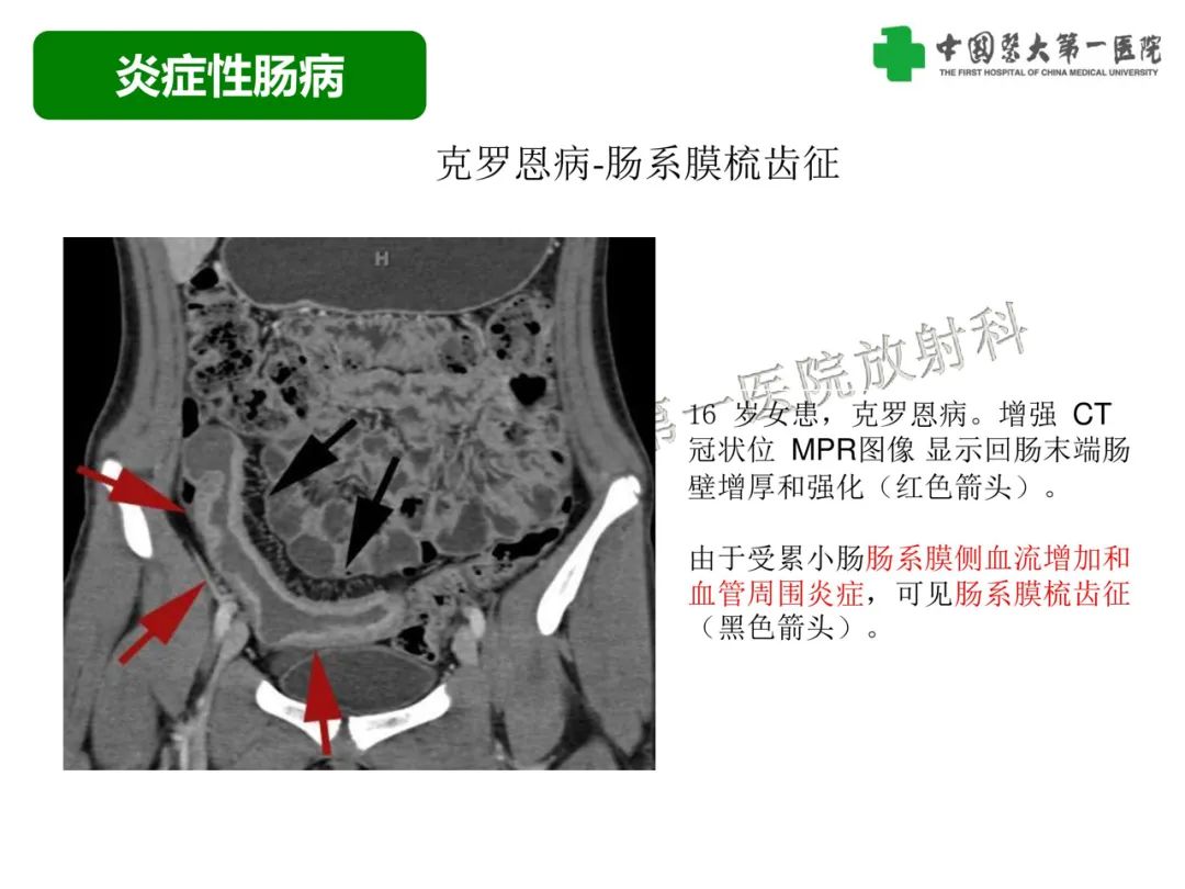 影像PPT - 【PPT】急性感染性 炎症性及缺血性肠炎的鉴别-22