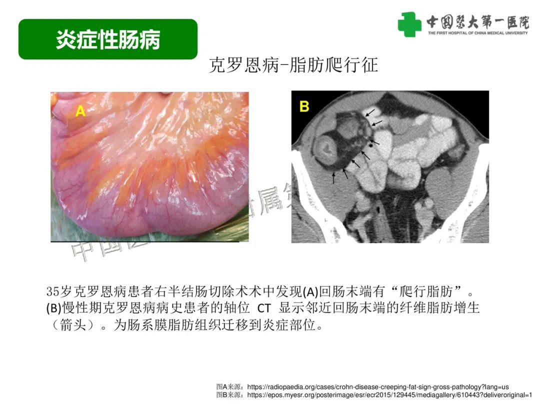 影像PPT - 【PPT】急性感染性 炎症性及缺血性肠炎的鉴别-23