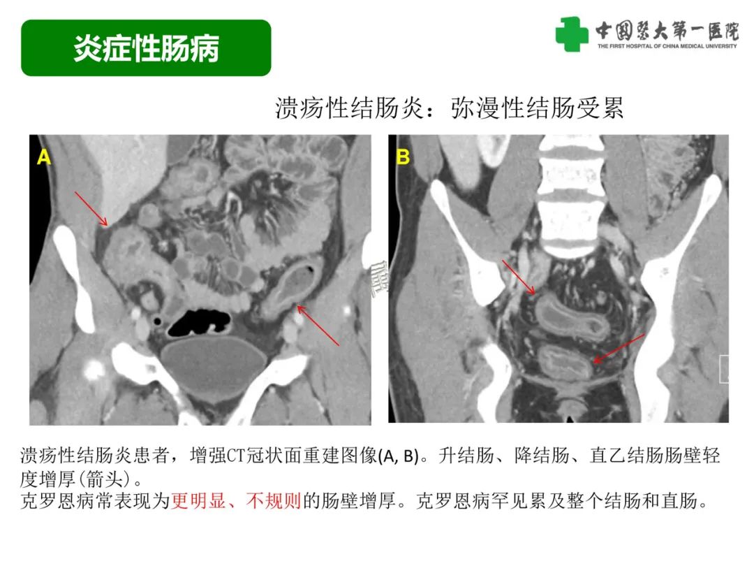 影像PPT - 【PPT】急性感染性 炎症性及缺血性肠炎的鉴别-26