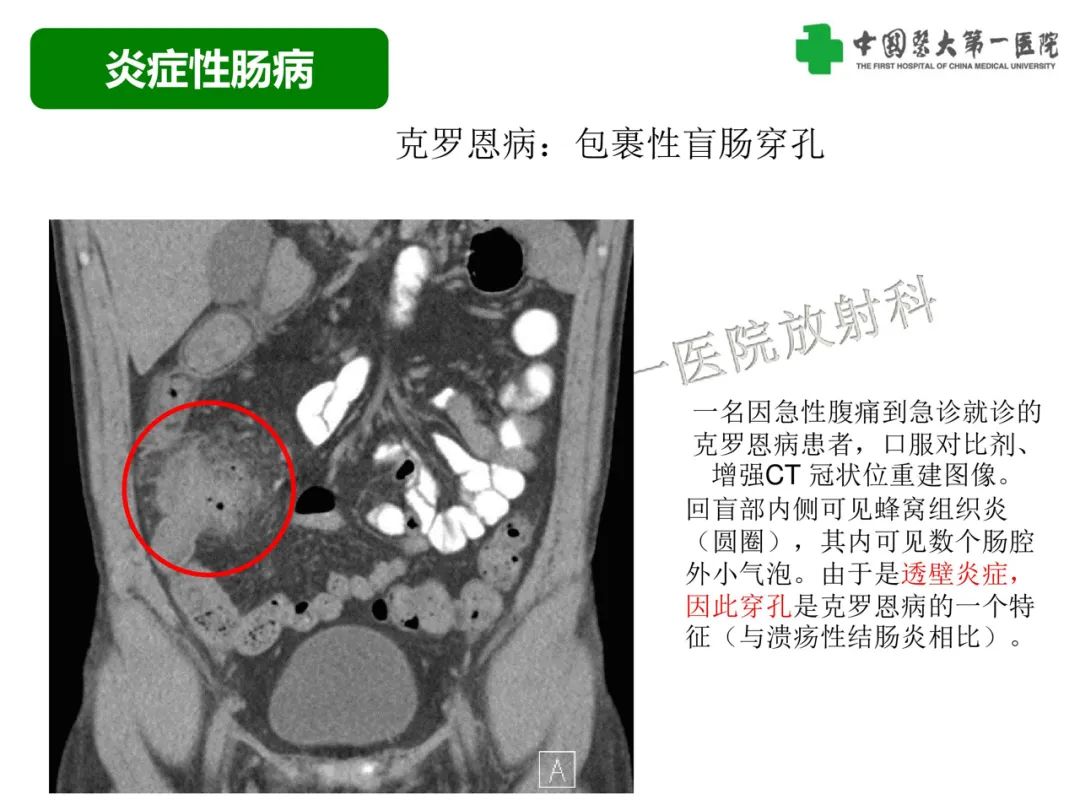 影像PPT - 【PPT】急性感染性 炎症性及缺血性肠炎的鉴别-25