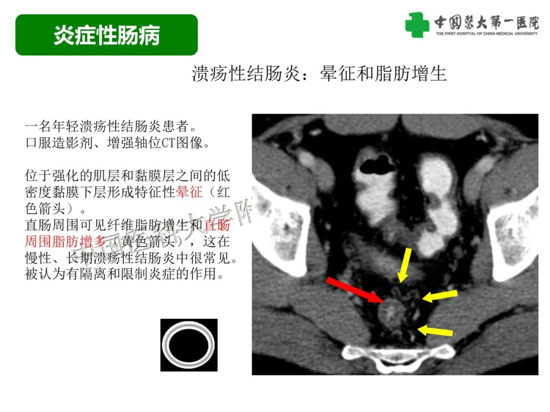 影像PPT - 【PPT】急性感染性 炎症性及缺血性肠炎的鉴别-27