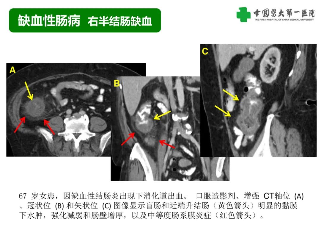 影像PPT - 【PPT】急性感染性 炎症性及缺血性肠炎的鉴别-29