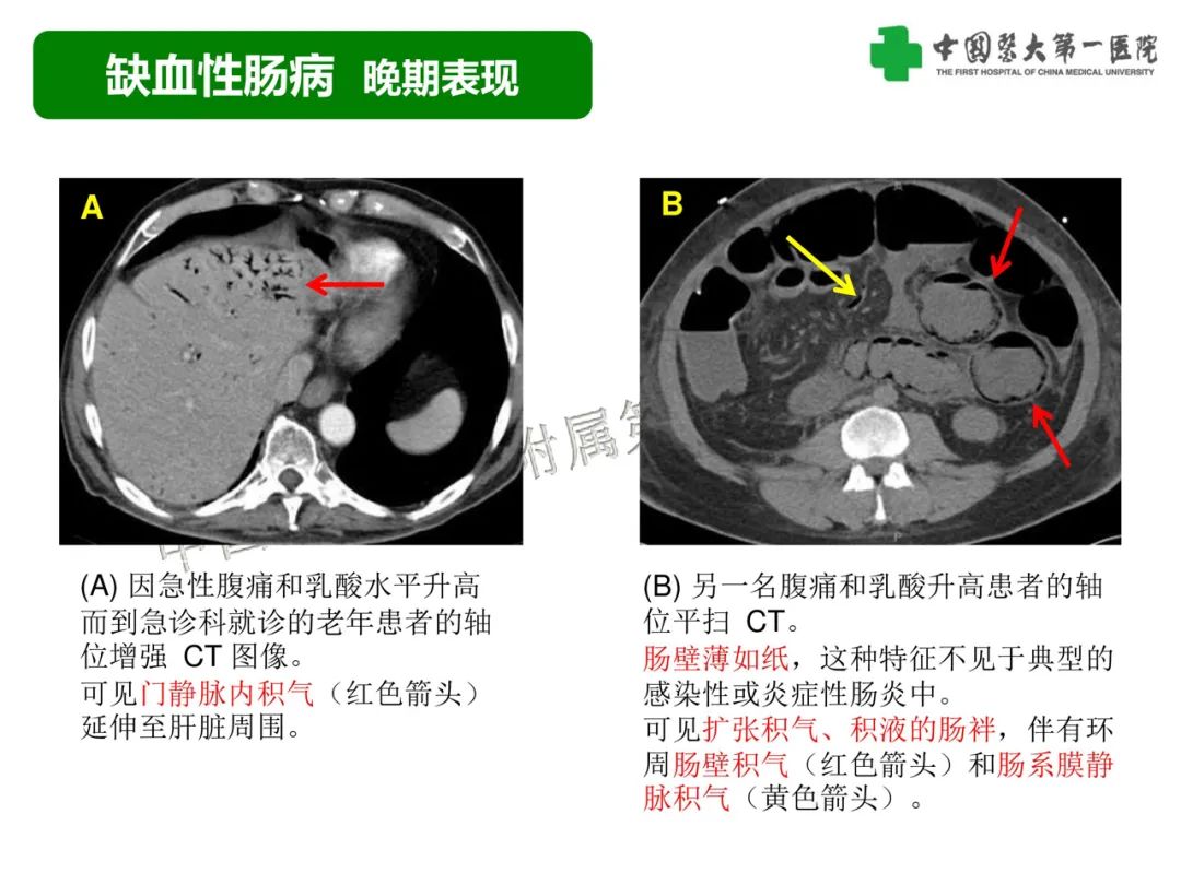 影像PPT - 【PPT】急性感染性 炎症性及缺血性肠炎的鉴别-32