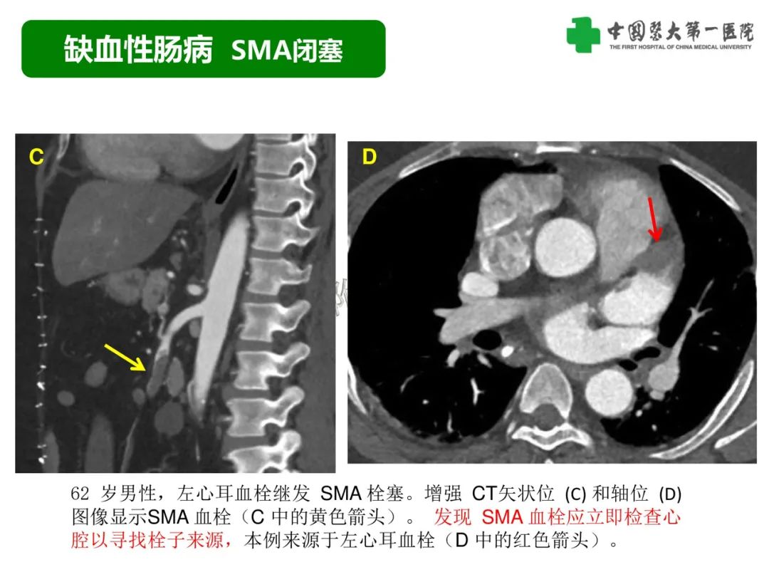 影像PPT - 【PPT】急性感染性 炎症性及缺血性肠炎的鉴别-35