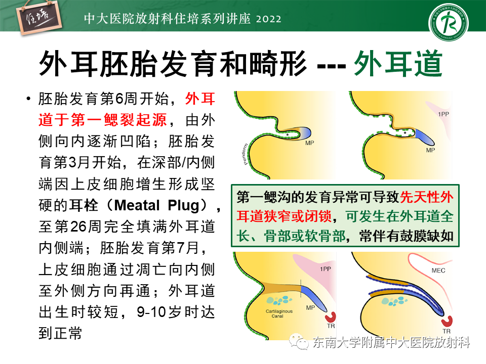 影像PPT - 【PPT】耳颞部发育异常影像评估-14