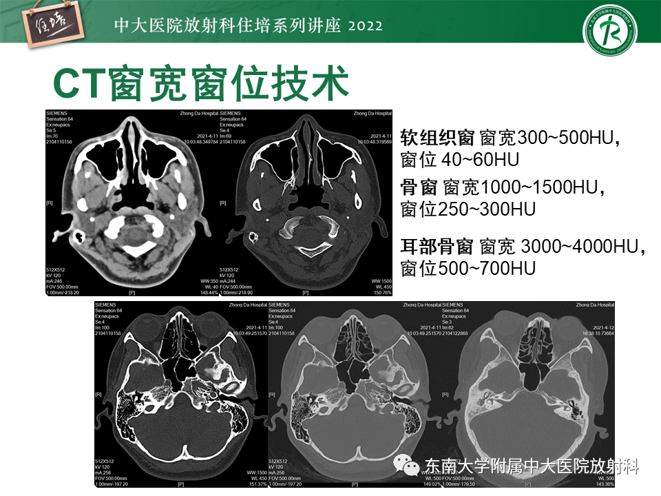 影像PPT - 【PPT】耳颞部发育异常影像评估-22