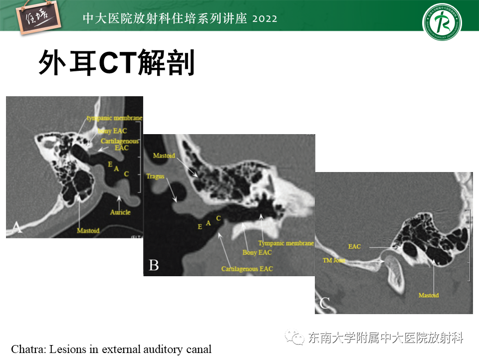影像PPT - 【PPT】耳颞部发育异常影像评估-24