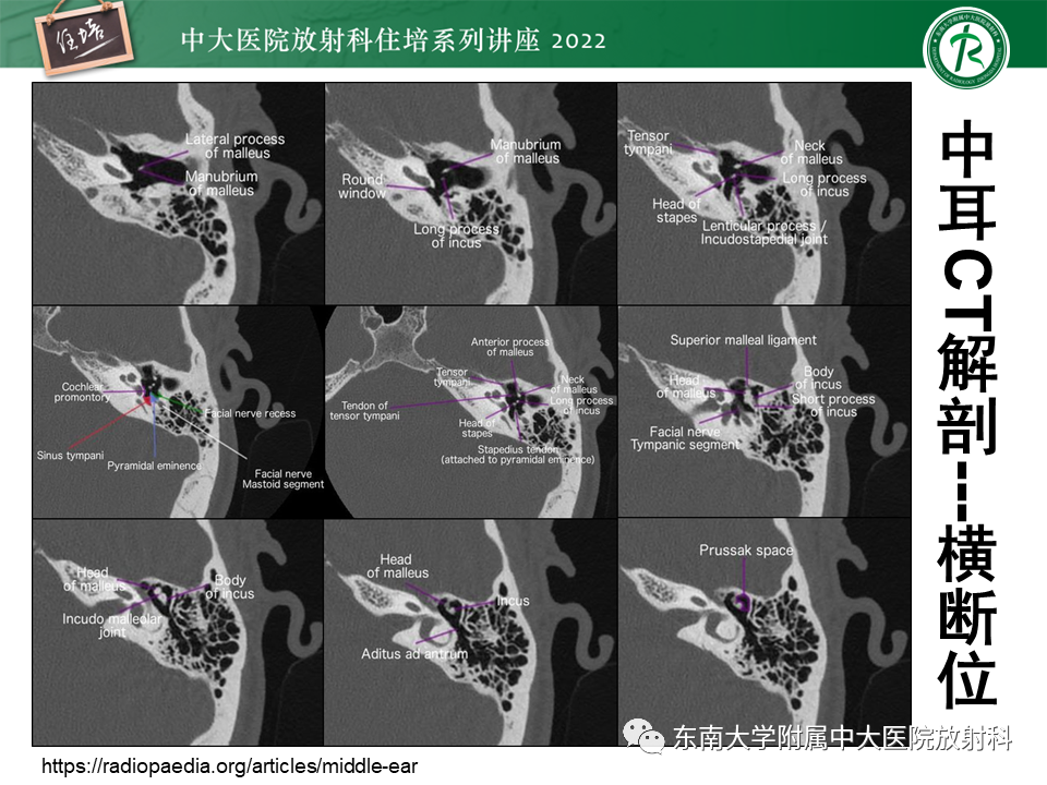 影像PPT - 【PPT】耳颞部发育异常影像评估-25